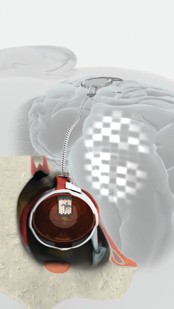 First implant of an early prototype bionic eye with 24 electrodes