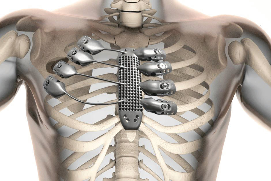 World-first operation implants – 3D printed titanium ribcage and sternum